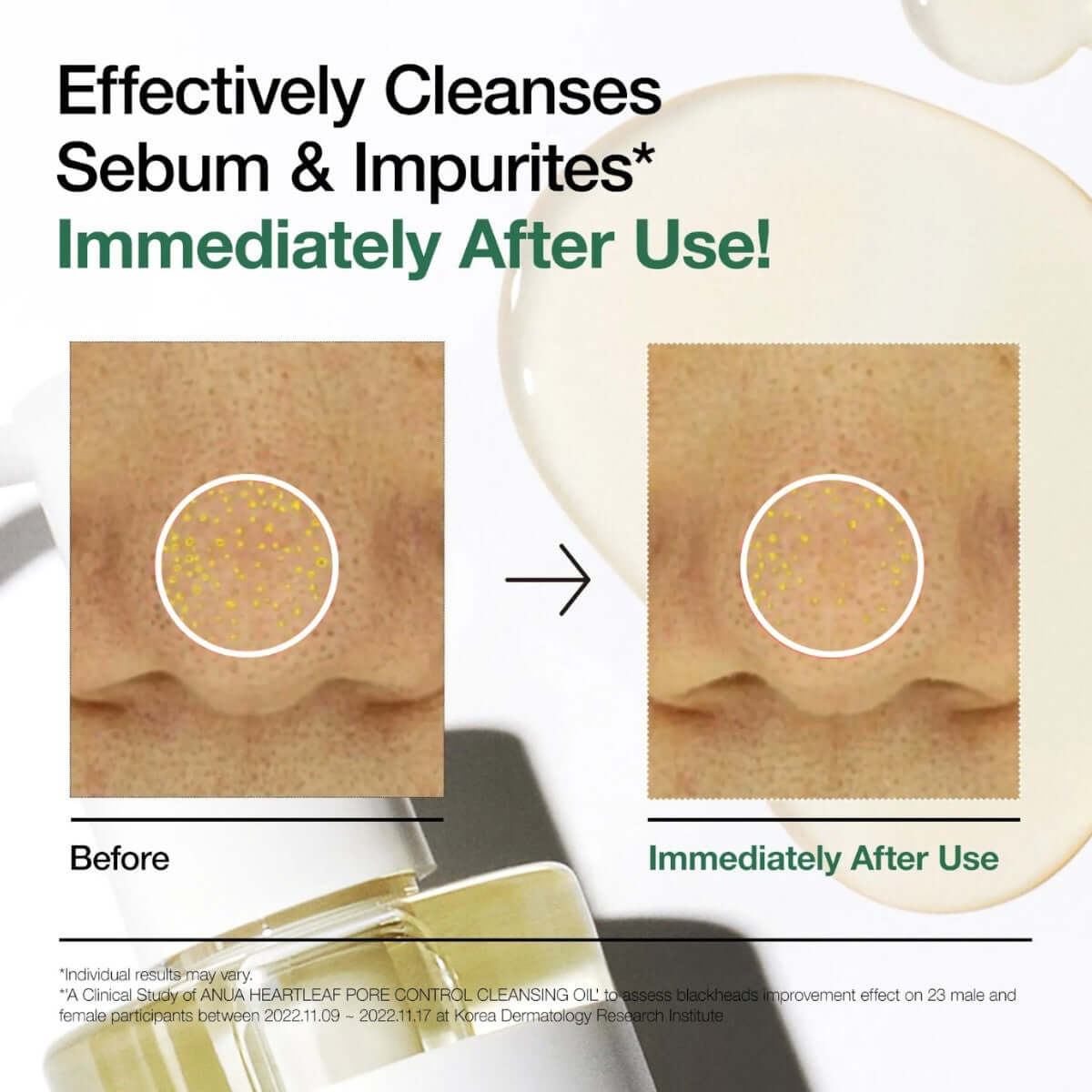 Before and after results of Anua Heartleaf Pore Control Cleansing Oil showing sebum and impurities effectively cleansed.