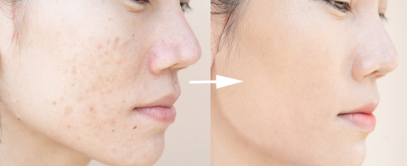 Damaged skin barrier routine