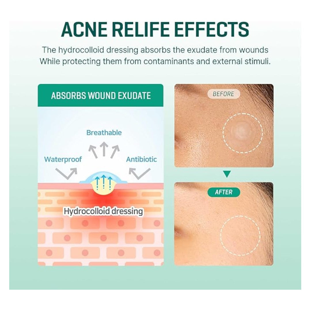 SOME BY ME 30 Days Miracle Clear Spot Patch SOME BY ME