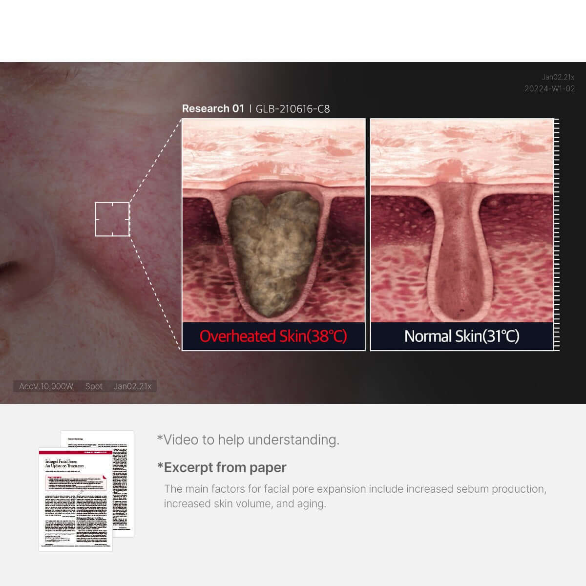 Comparison of overheated and normal skin with a heart-shaped object, likely representing a pimple or cyst, on a digital screen.